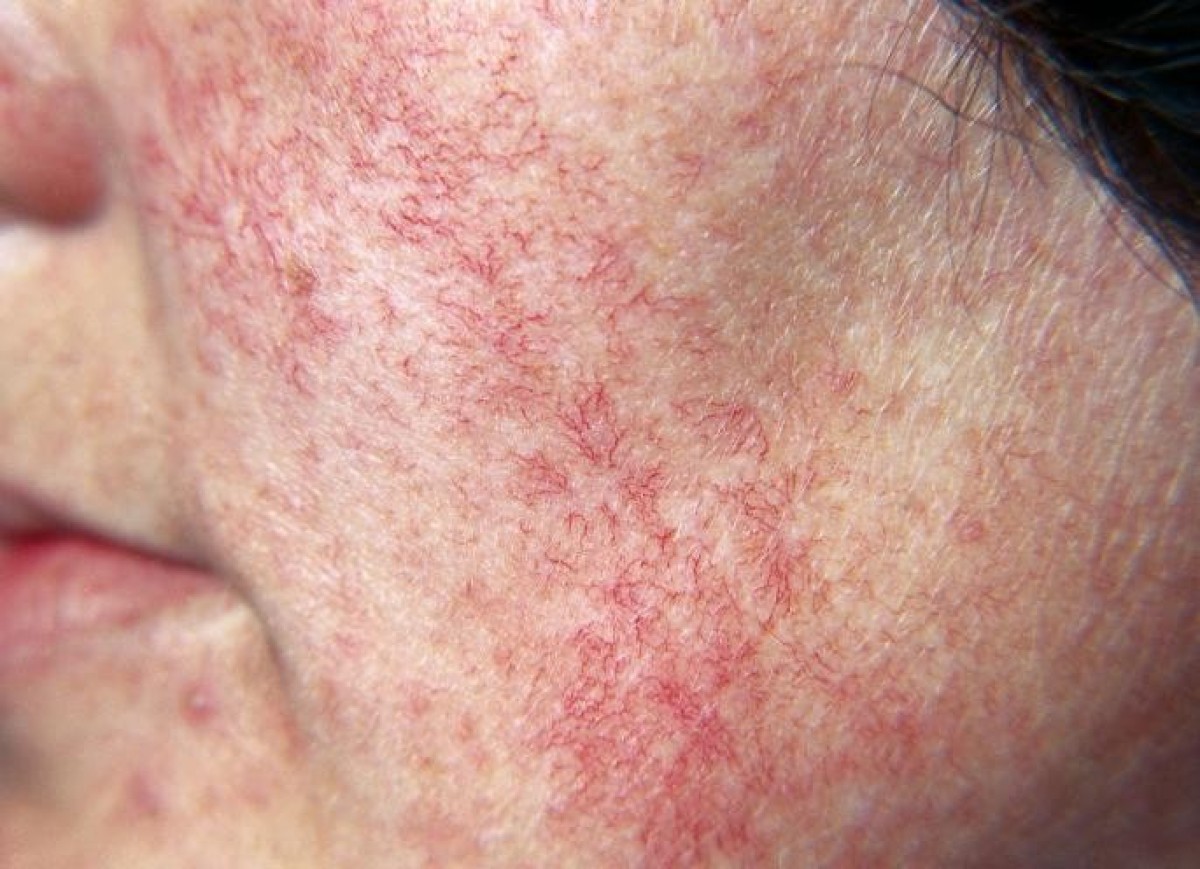 Natural helpers against broken capillaries