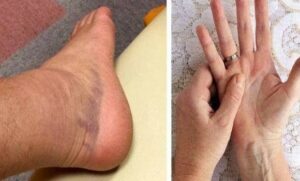 What early symptoms does dangerous bone cancer present with?