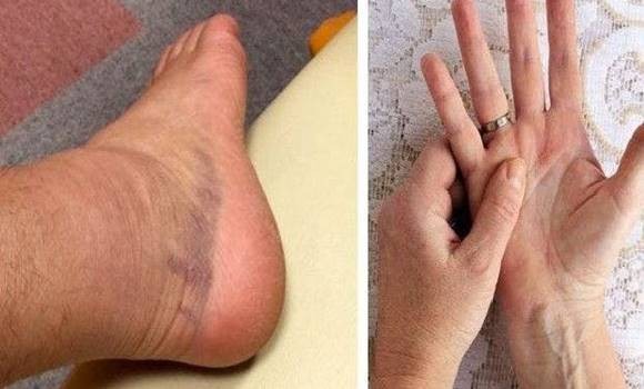 What early symptoms does dangerous bone cancer present with?