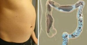 Bloated belly and pains: a guaranteed recipe for preventing bloating and effectively fighting it.