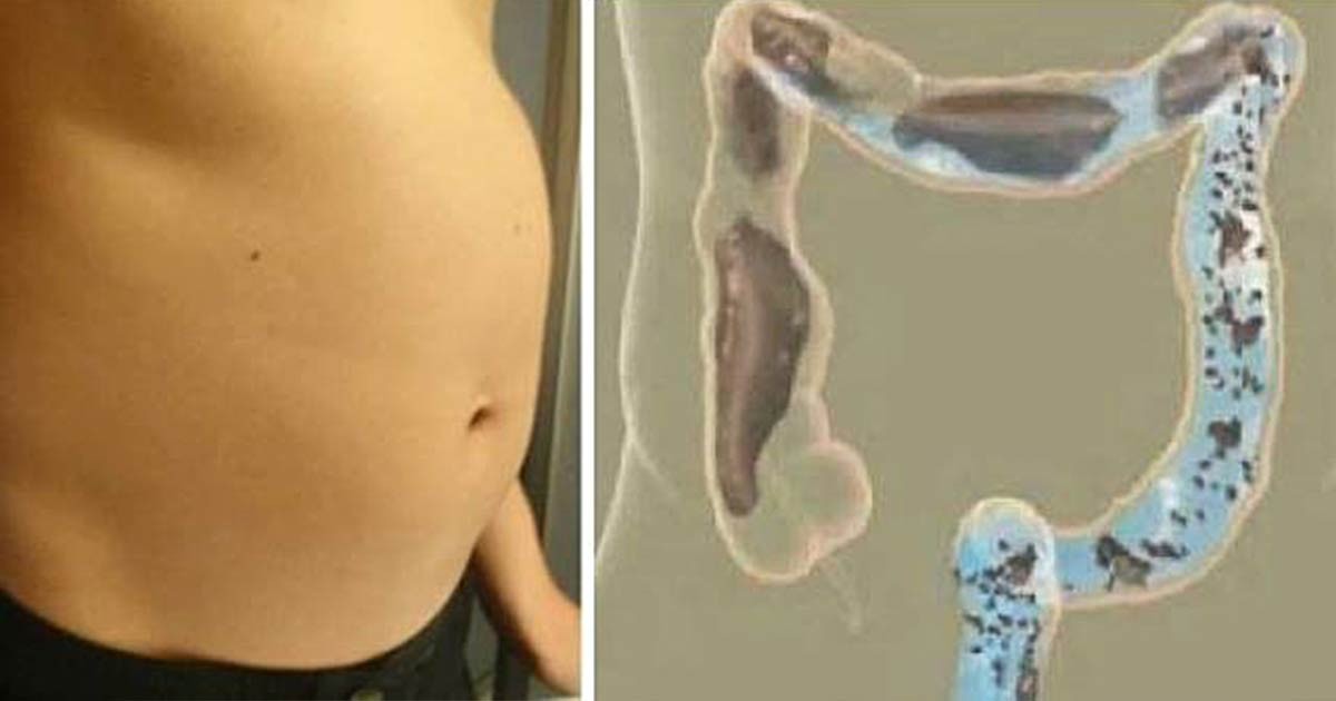 Bloated belly and pains: a guaranteed recipe for preventing bloating and effectively fighting it.