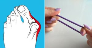 How to get rid of a deviated big toe without an outpatient procedure, at home and painlessly? Try this method.