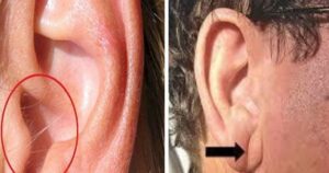 When my wife saw my ear hair and the crease on my earlobe, she made me see a doctor. This is what it can mean.