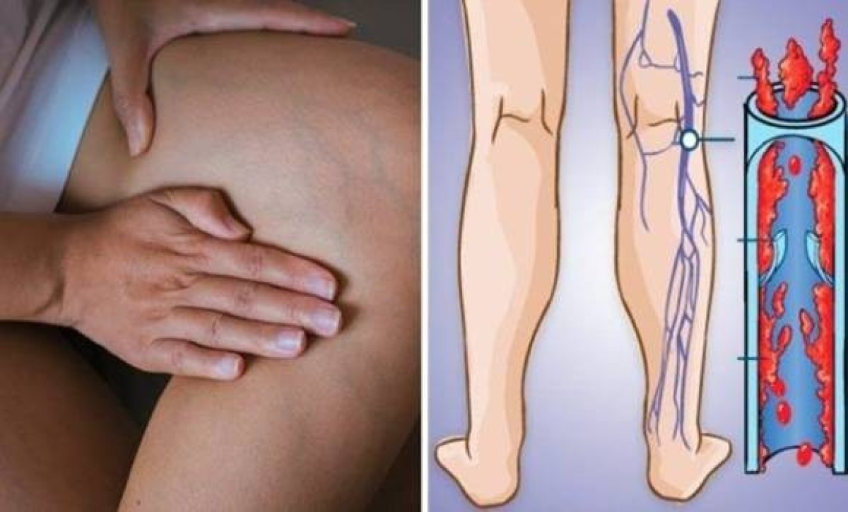 We'll show you how to detect a life-threatening blood clot in time