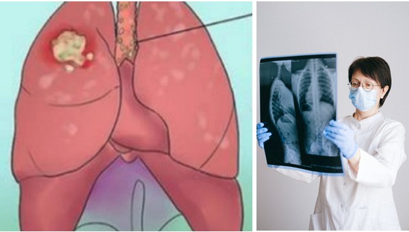 Doctors are starting to claim that if you catch lung cancer at an early stage, it is TREATABLE!