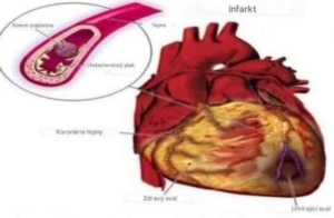 Start your day right: Drinking water on an empty stomach to prevent heart attacks
